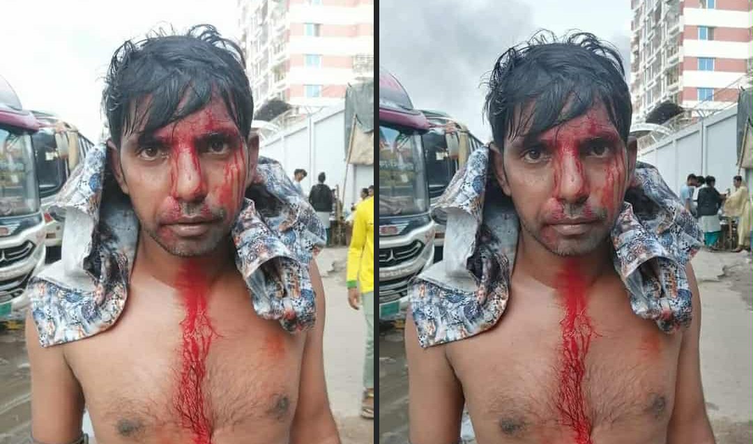 জুলাই আন্দোলনের অন্যতম যোদ্ধা লক্ষীপুর জেলা স্বেচ্ছাসেবকদল এর সহ-সাধারণ সম্পাদক মো: সুমনের মানবেতর জীবন,দেখার যেন কেউ নেই